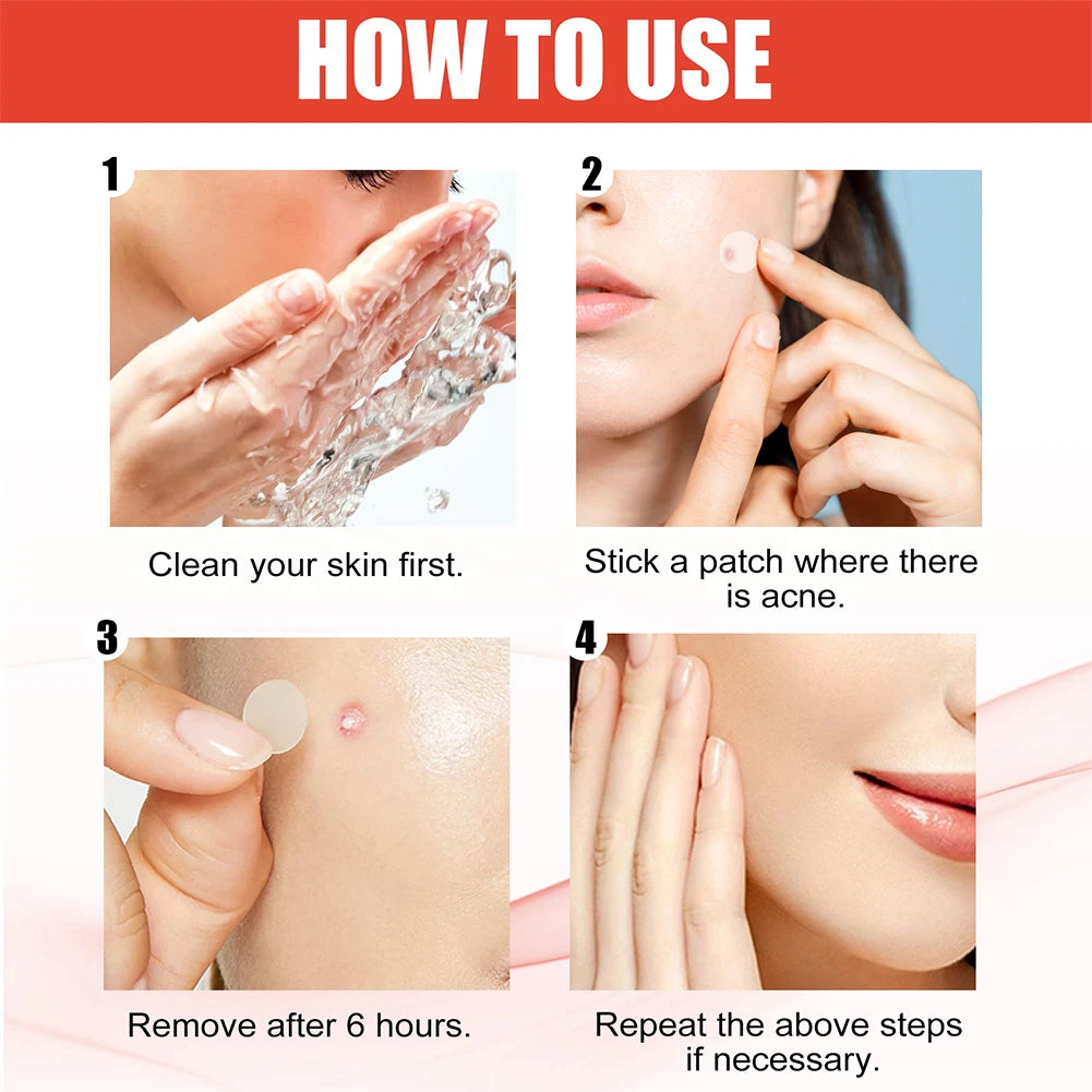 The Zit Zapper