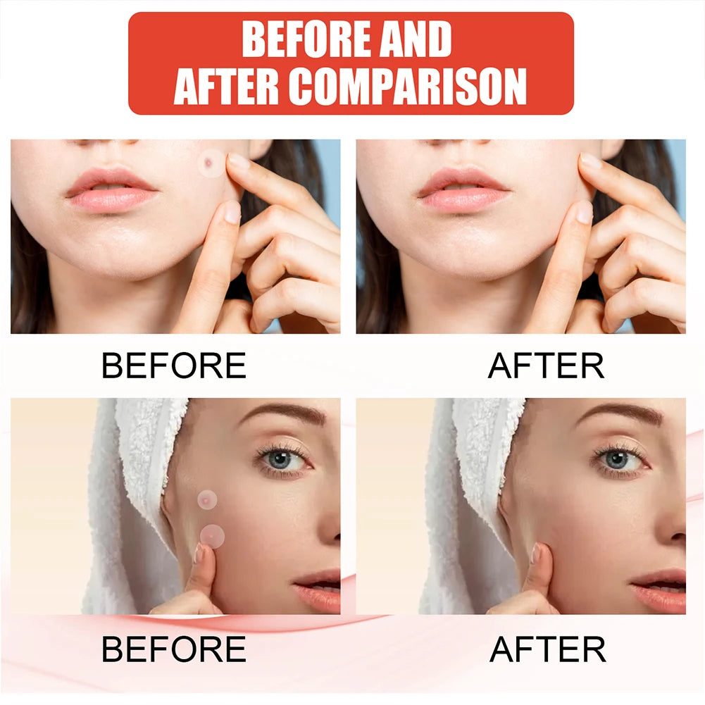 The Zit Zapper