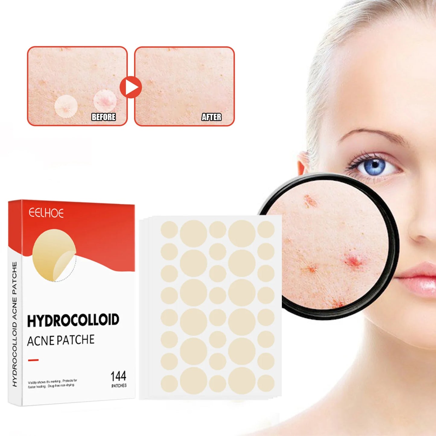 The Zit Zapper