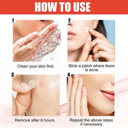 The Zit Zapper