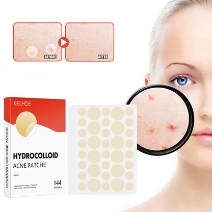 The Zit Zapper